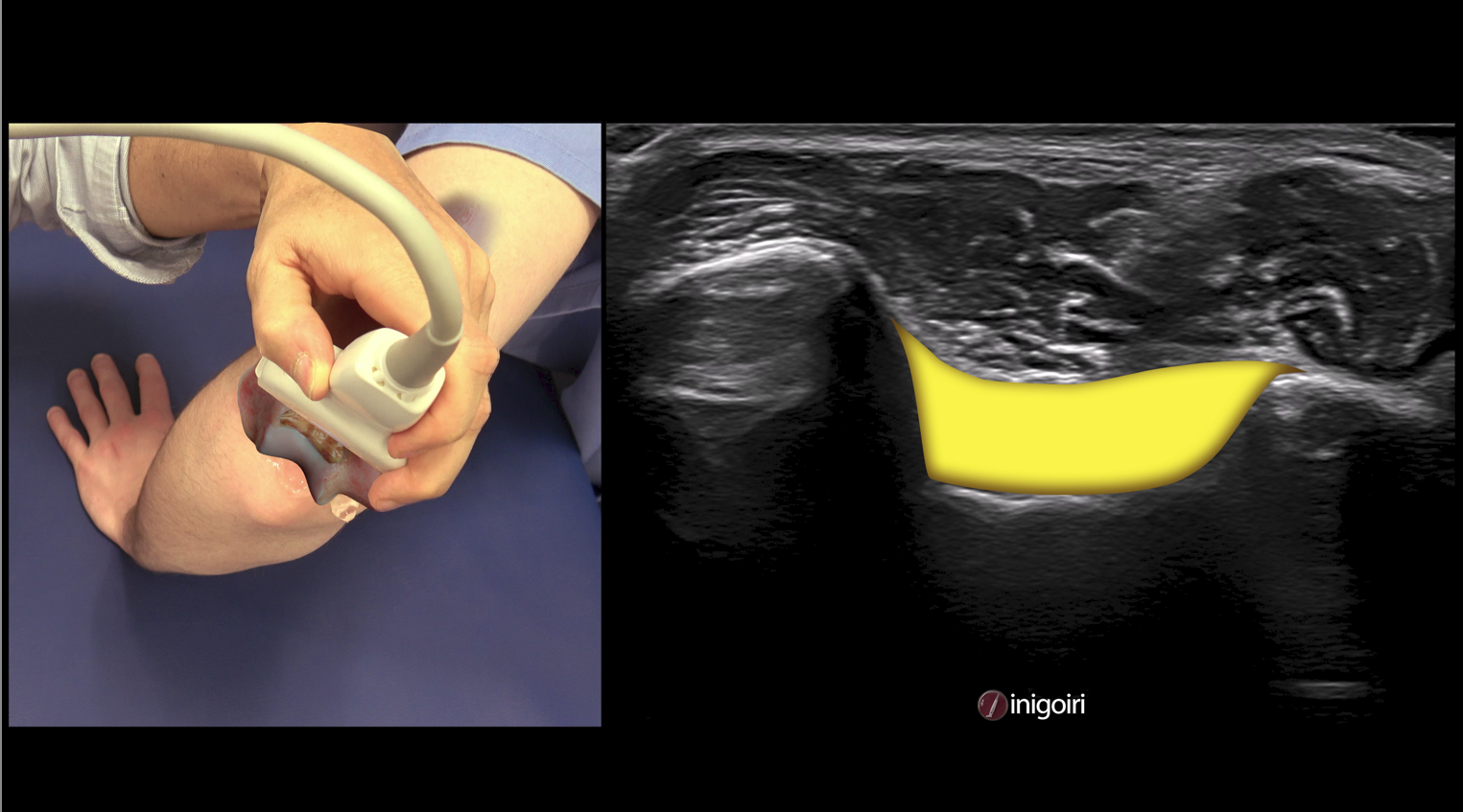 Doppler en Ecografía Musculoesquelética 3